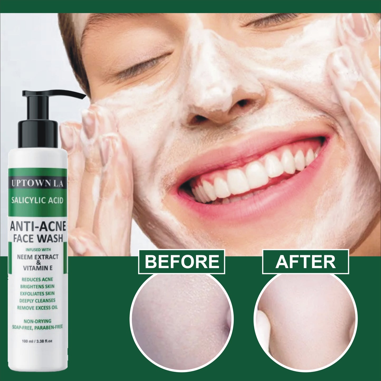 UPTOWN LA Anti Acne Face Wash – Prevents Acne Eruptions, Removes Excess Oil, Reduces Blackheads & Whiteheads